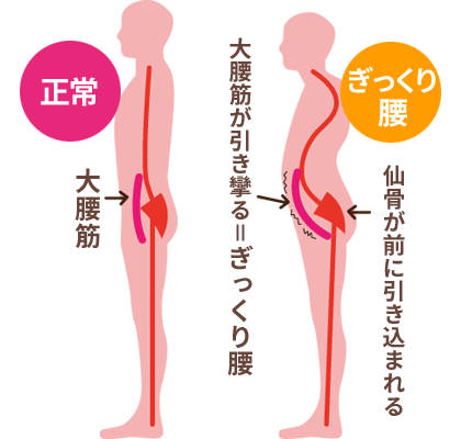 ぎっくり腰のプロセス