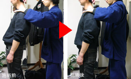 椎間板ヘルニア