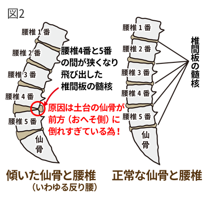 椎間板ヘルニアのメカニズム2